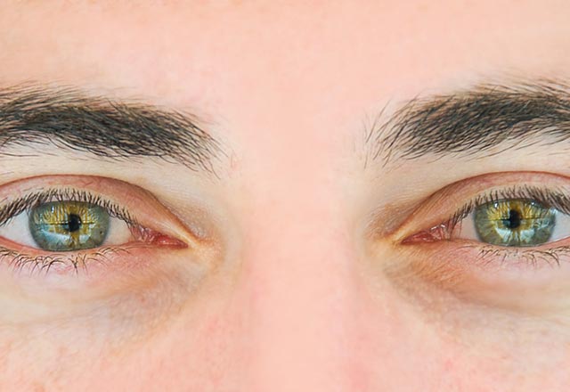 ریسک سرطان در افرادی که دارای چشمان روشن هستند