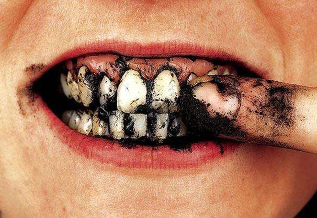 از بین بردن لک و جرم دندان 