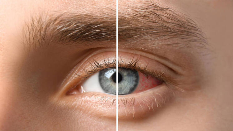 5 روش برای جلوگیری از خشکی چشم